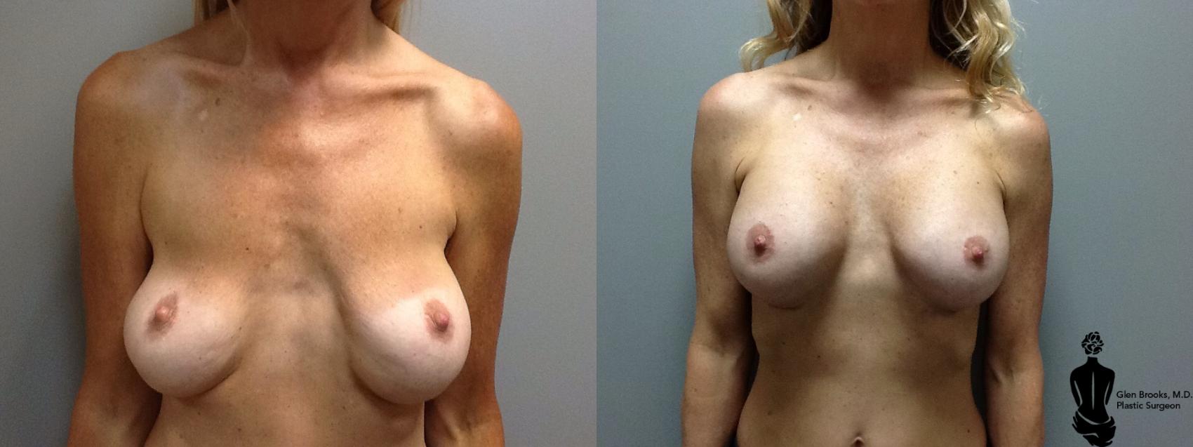 Boob Job Before And After Nude photo 3