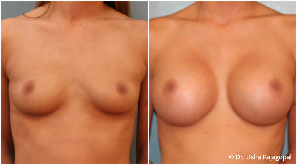 Boob Job Before And After Nude photo 5