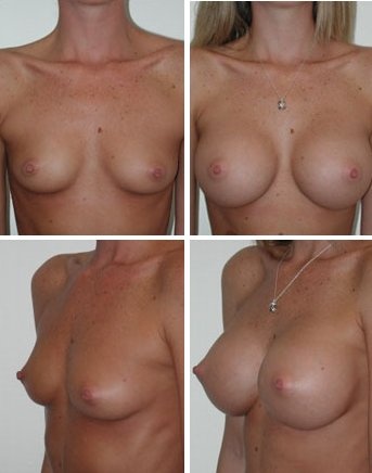 Boob Job Before And After Nude photo 10