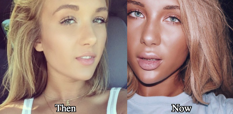 Niykee Heaton Before And After Surgery photo 5